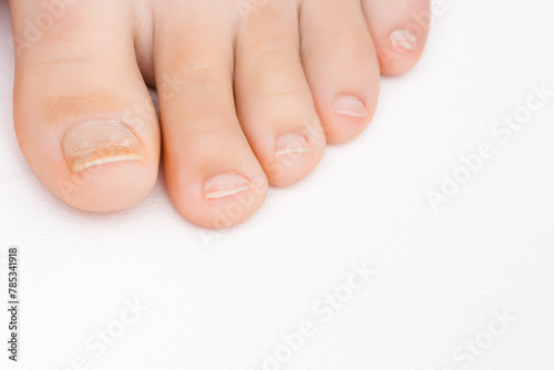 Young adult woman barefoot on white background. Dry damaged toe nails. Closeup. Front view.