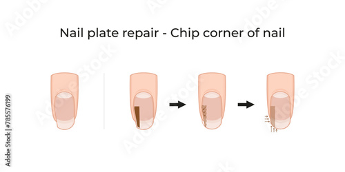 Nail plate repair - Chip corner of nail