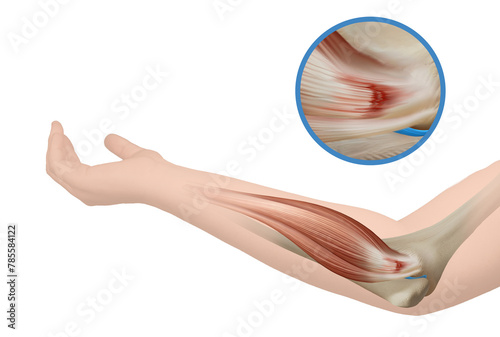 Golfer's Elbow - Medial Epicondylitis_Medical Illustration_Elbow Pain_Elbow anatomy illustration photo
