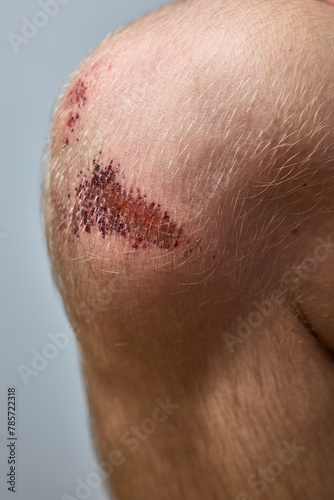 scratch, knee wound on a man's knee