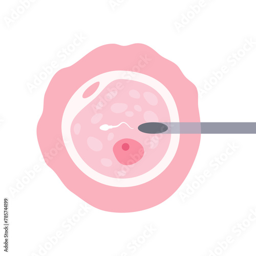 Intracytoplasmic sperm injection (ICSI). Intracytoplasmic sperm injection, ICSI, as part of IVF process