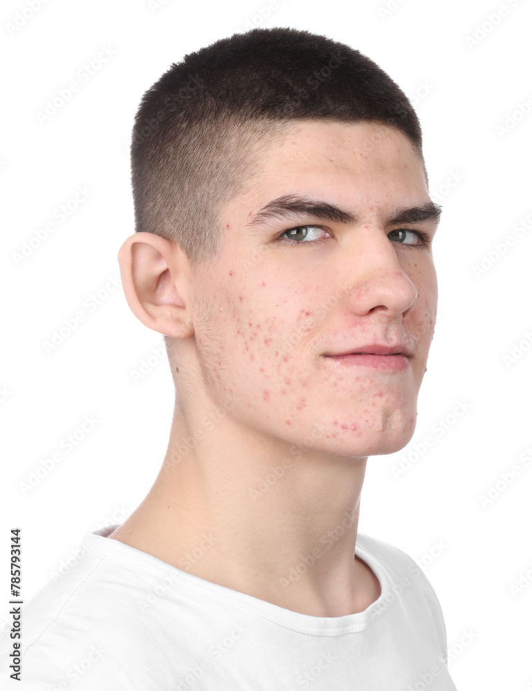 Young man with acne problem isolated on white Young man with acne problem isolated on white