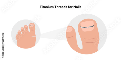Titanium threads for nails, podiatrist 