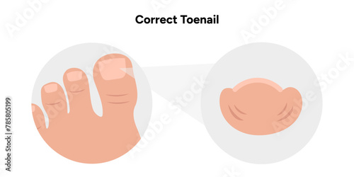 Titanium threads for nails, podiatrist, correct toenail