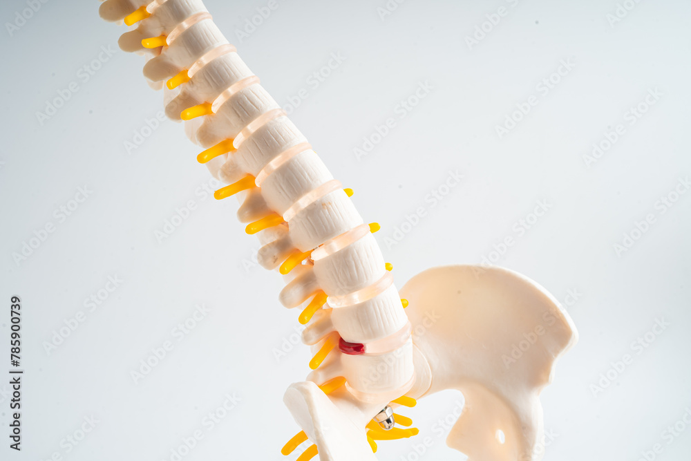 Lumbar spine displaced herniated disc fragment, spinal nerve and bone ...