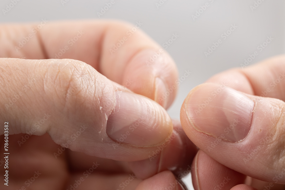 Ridged fingernail of a thumb finger of a man with horizontal ridges on white background. Ridged fingernail of a thumb finger of a man with horizontal ridges on white background.