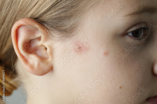 Facial skin closeup. Allergy, dermatitis, virus or bacterial infection. Dermatology,  medicine and health care concept. photo