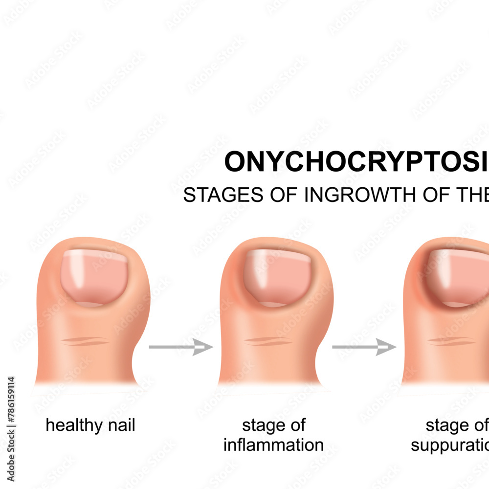 Onychogryphosis Stages of Ingrowth of the Toe Nail Stock Vector | Adobe ...