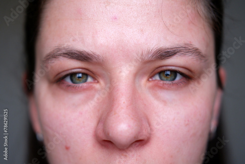 woman's face close-up. problem skin in a woman. rashes, pimples, wrinkles, redness, dark circles on a woman’s face. young woman with rashes on her face