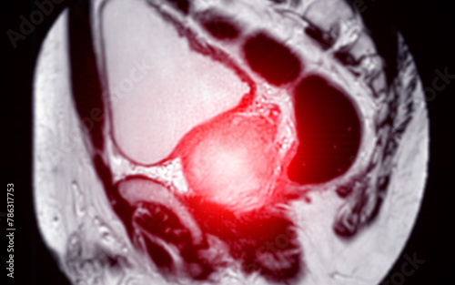 MRI of the prostate gland reveals a focal abnormal signal intensity (SI) lesion at the left posterolateral peripheral zones at the apex, aiding in diagnosing tumors and guiding treatment decisions. photo