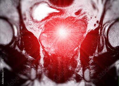 MRI of the prostate gland reveals a focal abnormal signal intensity (SI) lesion at the left posterolateral peripheral zones at the apex, aiding in diagnosing tumors and guiding treatment decisions.