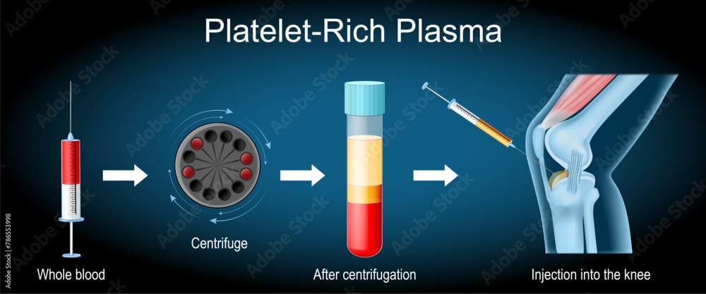 Platelet-rich plasma procedure. knee joint treatment.
