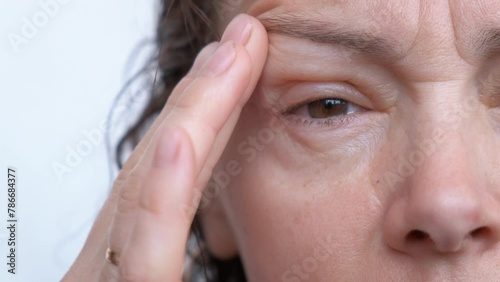 Eye allergies. Sad woman with puffy eyes. Seasonal allergies concept. photo