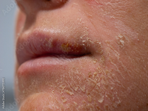 CLOSE UP, DOF: Dry and flaky facial skin of an unknown woman after sun exposure. Harmful consequences due to carelessness in summer sunbathing, which can gradually lead to development of skin cancer.
