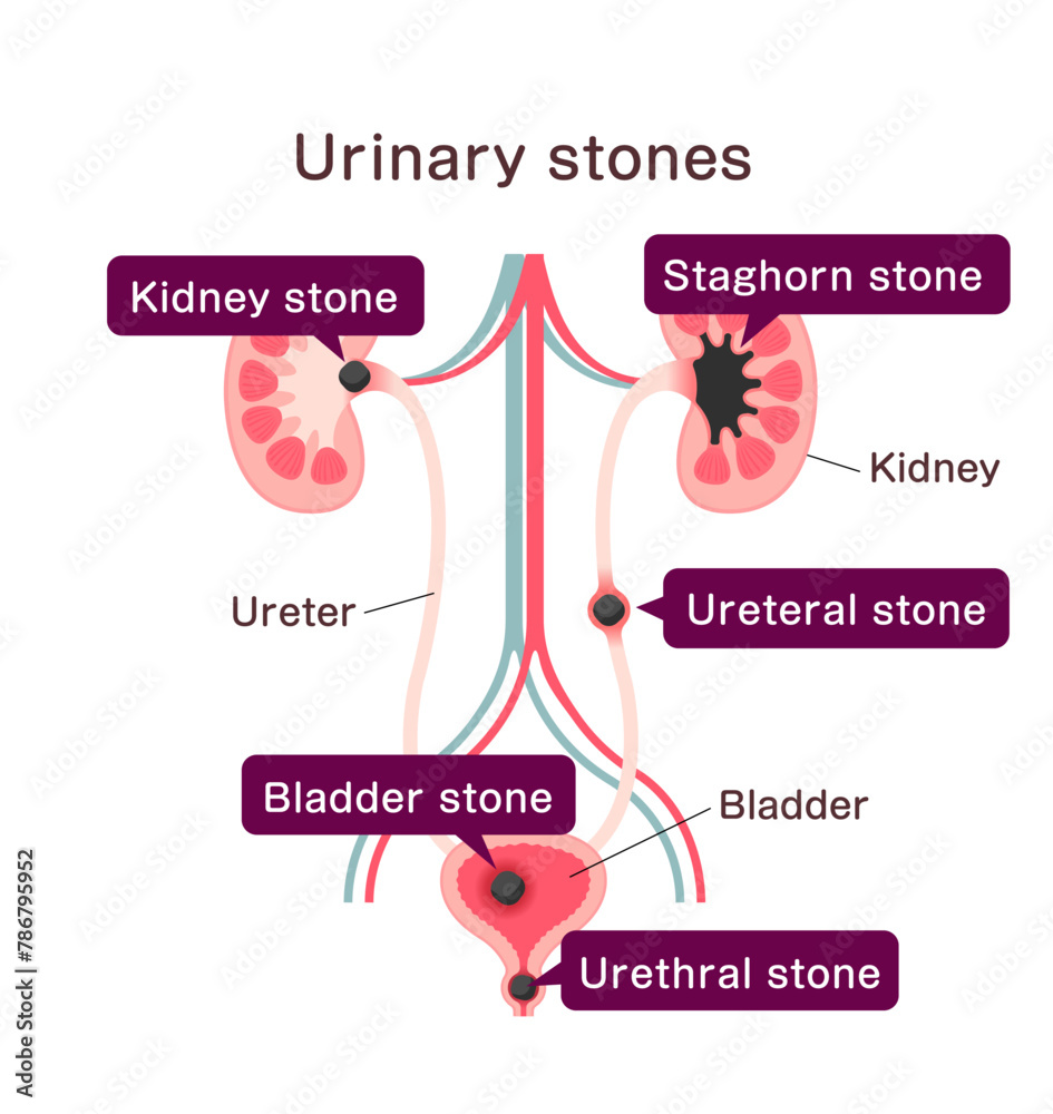 Fototapeta premium Urinary stones ( Kidney stones ) vector illustration
