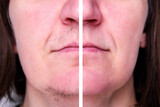 Woman's face with moustache and hairs on chin. Before and after hair removal and epilation.