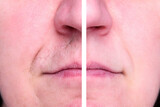Woman's face with moustache over her upper lip. Before and after hair removal and epilation.