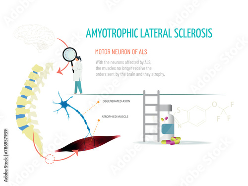 A doctor looks at a spinal column with a magnifying glass. She checks that the signal from the brain does not reach the muscle due to the disease. Amytrophic lateral sclerosis concept.