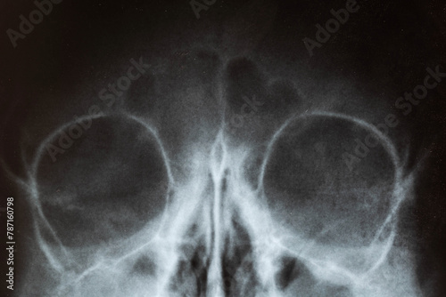 X-ray image of the skull of a child with purulent sinusitis, close-up. Treatment of inflamed sinuses, purulent secretion photo