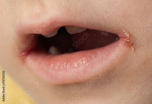slit-like impetigo in a little girl in the corners of her mouth. Skin wounds. Dermatological bacterial disease. Sticky lips, close-up, angulitis photo