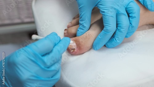 The podiatrist examines the nail and applies an antifungal treatment photo