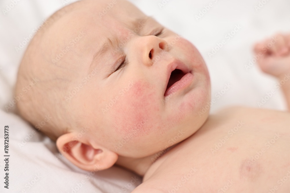 Cute little baby with allergic redness on cheeks lying on white blanket, closeup Cute little baby with allergic redness on cheeks lying on white blanket, closeup