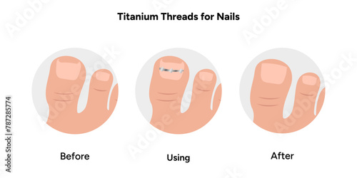 Titanium threads for nails podiatrist