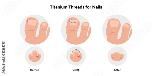 Titanium threads for nails, podiatrist 
