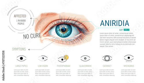 Illustration of an eye showing the absence or lack of iris, a symptom of the disease called Aniridia. On a white background some of the symptoms. Eye created with AI the rest Vector