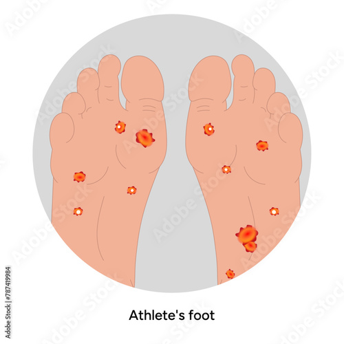 Athlete's foot