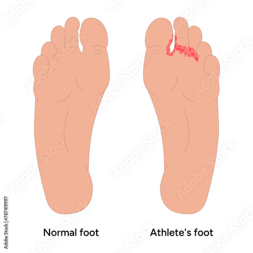Normal and Athlete's foot