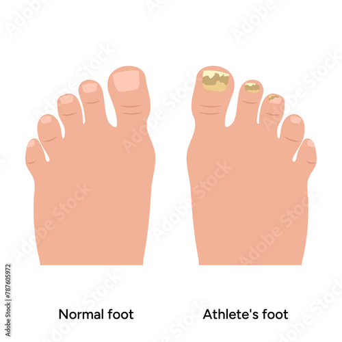 Normal and athletes foot. Fungus nails. Podiatrist disease 