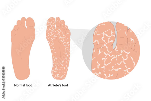 Normal and athletes foot. Shelling foot. Podiatrist disease 