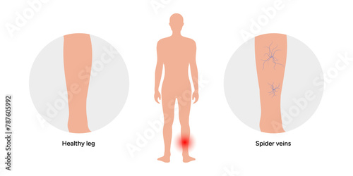 Varicose vein. Healthy leg and spider veins