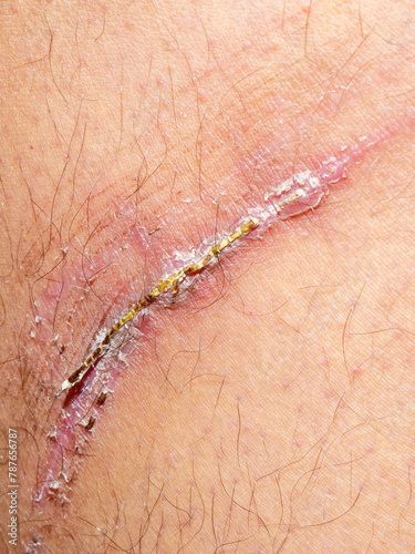 Close-Up of Skin Regeneration. Scab Formation in Healing Process