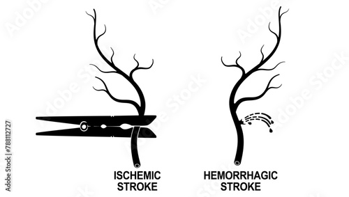 Different Types of Stroke, Ischemic Stroke, Hemorrhagic Stroke, black isolated silhouette