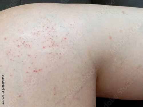 Itchy rash on the skin of the legs