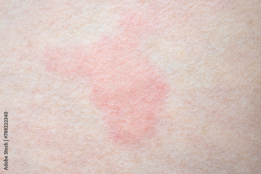 Skin allergy rash dermatitis texture close up Skin allergy rash dermatitis texture close up