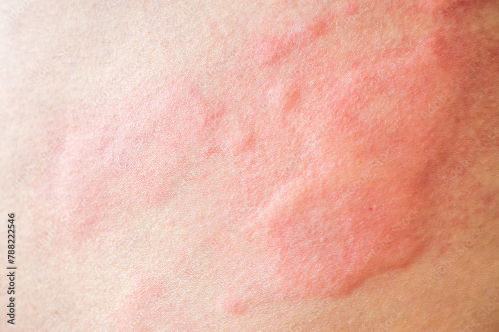 Skin allergy rash dermatitis texture close up background