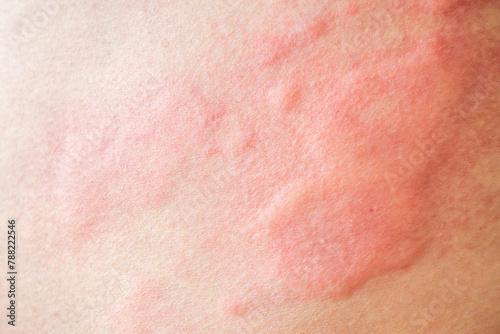 Tableau sur toile Skin allergy rash dermatitis texture close up background