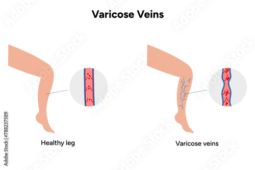 Normal and Varicose veins