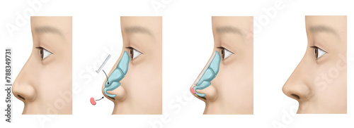 rhinoplasty