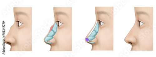 hooked nose surgery