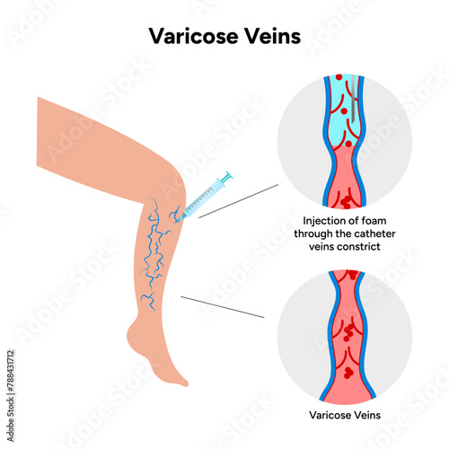 Normal and Varicose vein treatment, Sclerotherapy 