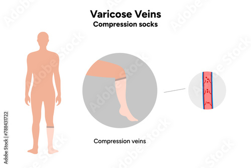 Compression socks and Varicose veins