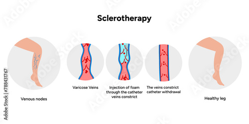 Normal and Varicose vein treatment, Sclerotherapy 