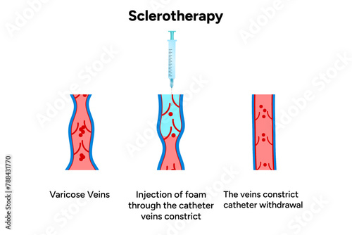 Normal and Varicose vein treatment, Sclerotherapy 