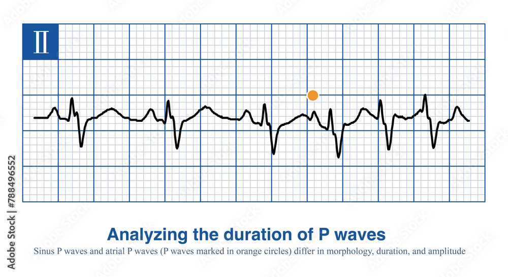 When intraatrial excitation is transmitted from one atrium to the other, a wider duration of P waves are generated, such as sinus rhythm, lateral left atrial focal, etc. When intraatrial excitation is transmitted from one atrium to the other, a wider duration of P waves are generated, such as sinus rhythm, lateral left atrial focal, etc.