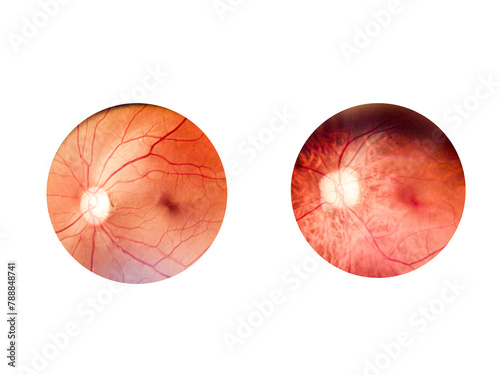 Patient elderly with retina of diabetes.Human eye anatomy taking images with Mydriatic Retinal cameras.