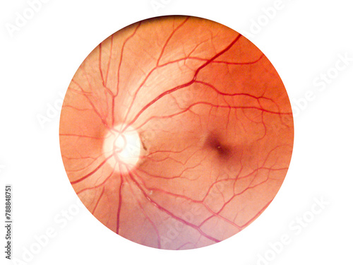 Patient elderly with retina of diabetes.Human eye anatomy taking images with Mydriatic Retinal cameras.